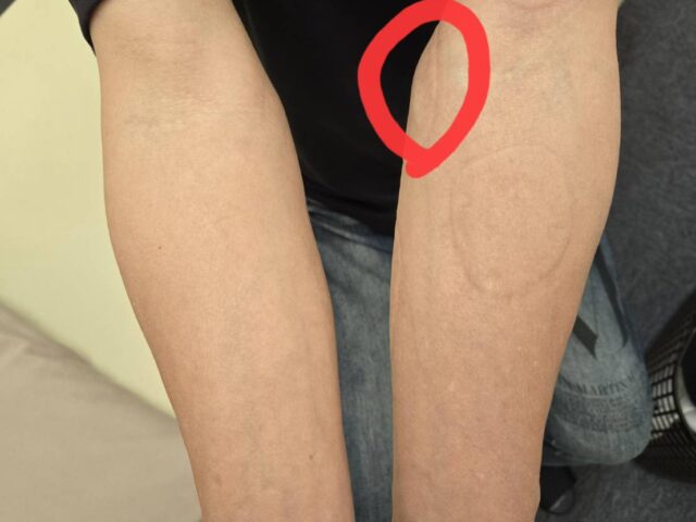 ゴルフ肘（上腕骨内側上顆炎）による肘の内側の痛み｜2〜3年間続いた症状が改善しゴルフへ復帰された症例